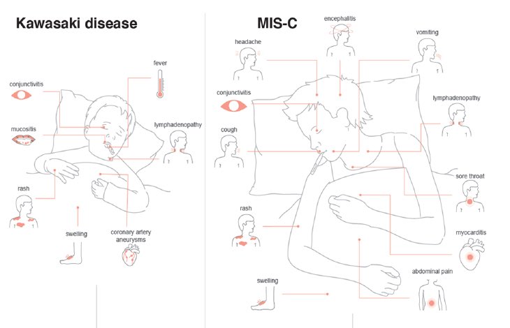 While there are some common features, MIS-C and Kawasaki disease differ in important areas. Non-overlapping symptoms and organ involvement, as well as the age group affected. Age in months in this study of MIS-C patients, 106 (71.1 - 165.4), and Kawasaki 24.5 (15.8 - 41.8). (2/)