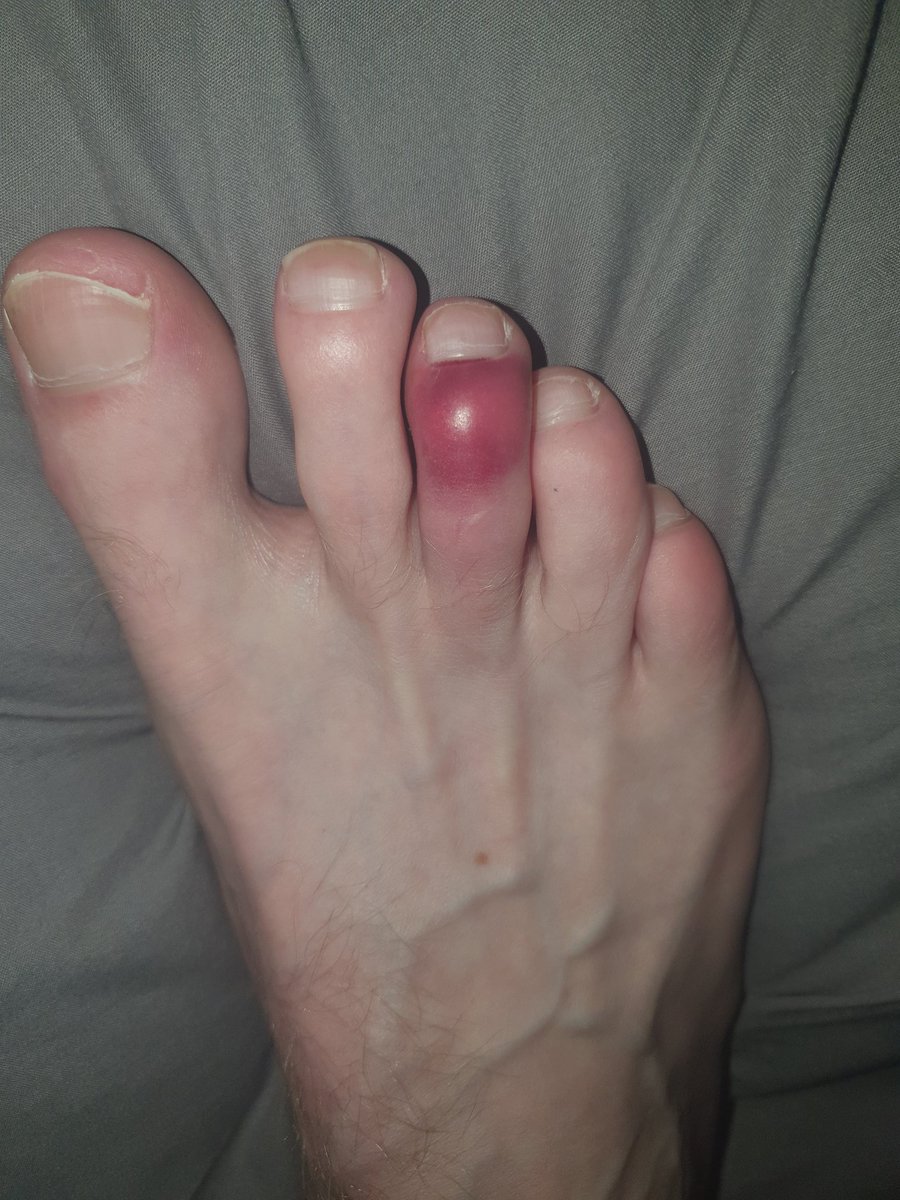 Cash_MasterJosh's tweet photo. You're all pathetic cuck losers🤣🤣🤣 #findom #cashmaster #fagcash #Footmaster #footfag 
Whos going to kiss my toe better ? 
Its broken like your fucking heads 🤯 https://t.co/vesoLYI2sv