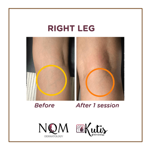 Patients' excellent result after 1 session for Varicose Veins using Cutera Laser Treatment.

#dermatology #skin #skindoctor #skinclinic #nqmdermatology #kutisdermatology #legazpi #laspinas #quezoncity #legazpidermatology #maniladermatology  #varicosevein #CuteraLaser