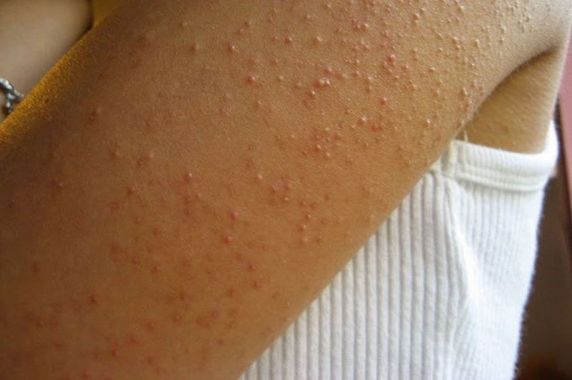 KERATOSIS PILARIS is a common, harmless skin condition that causes small, hard bumps that may make your skin feel like SANDPAPER. You may have heard it called “chicken skin.” There isn't really a cure. See more  #skinherball Please Retweet
