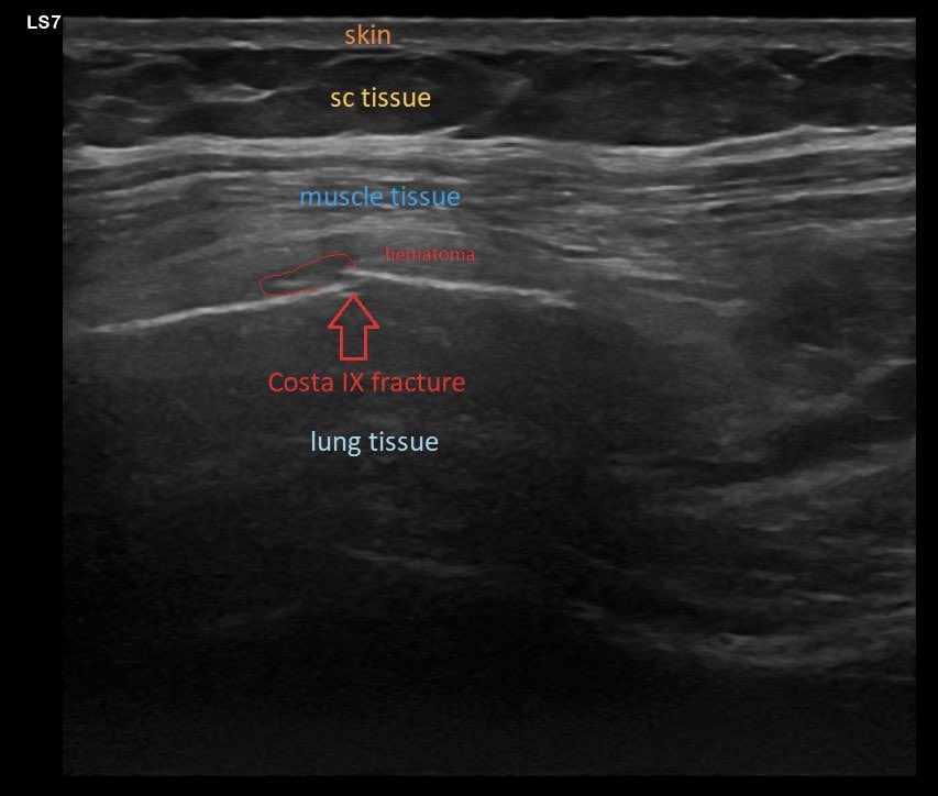 SportklinikBern's tweet photo. Ultrasound diagnostic of #ripfracture with #hematoma after bending over a bike saddle! #mskus #pocus #pocushub #s7r3 #boneultrasound https://t.co/9EtKyTf5Vb