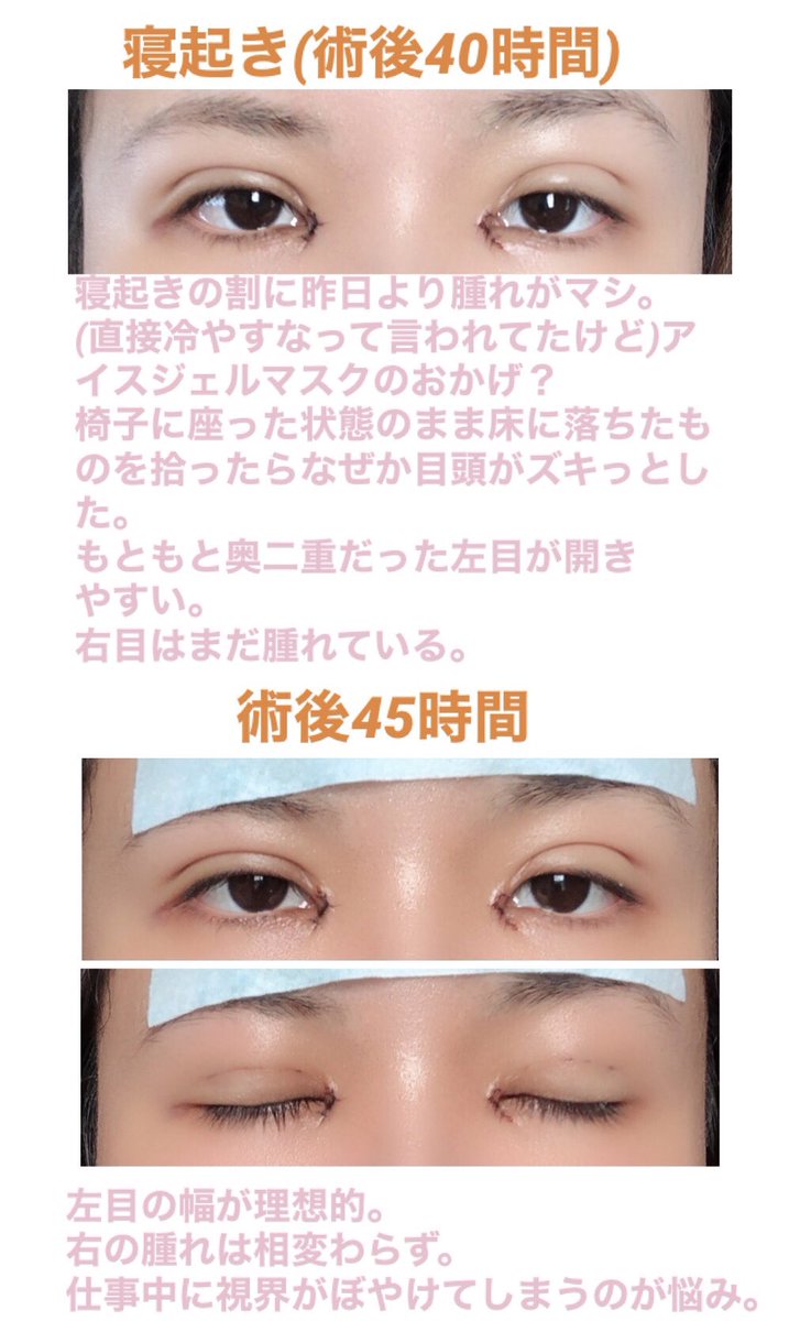 なつき度 術後48時間 2枚目の顔色死んでるのはノーマルカメラで撮ったせい 目頭切開 フォーエバー二重術 なつき度 術後48時間 2枚目の顔色死んでるのはノーマルカメラで撮ったせい 目頭切開 フォーエバー二重術