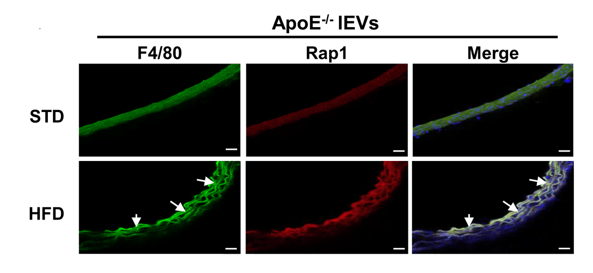 precisiondiagn4's tweet photo. RT @CircRes: Patients with #MetabolicSyndrome are at risk for #atherosclerosis.
This may be due to increased #Rap1 positive #ExtracellularVesicles in #blood that promote plaque formation https://t.co/9f86Ah1UHj
@xavidalgomez https://t.co/SsRIvQ3ZpO
