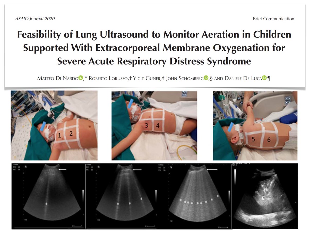 Lung #POCUS to assess #ARDS children on #ECMO consistently w adults feasible/effective
#LUS score significantly reduced as aeration improves; negative correlation w OI /increased MV settings)
Stable score (high) in non survivors bit.ly/35bG7iM #PedsICU #echofirst #FOAMus