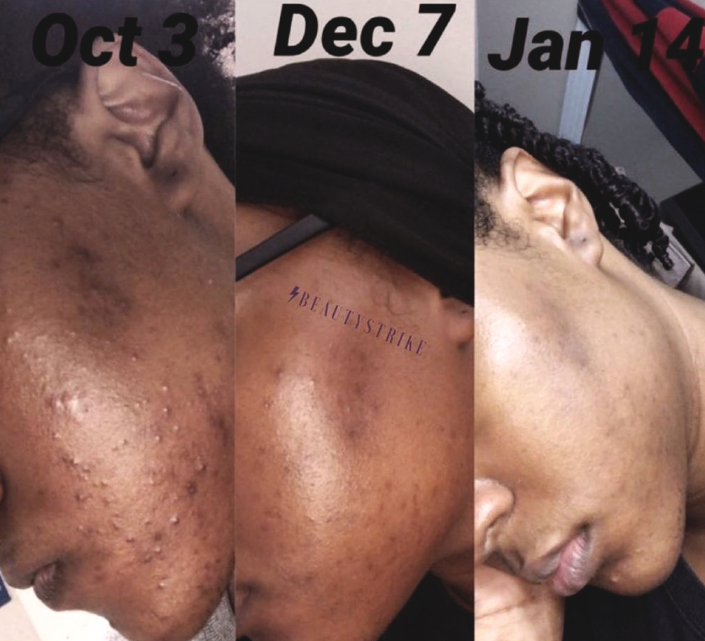 BeautyStrikeNY's tweet photo. All From Beauty Strike Skincare & Listening to your Esthetician. Did you know we use our entire skincare line in our spa? #blackownedspa #brooklynspa #blackownedskincare #fortgreen #clintonhill https://t.co/pa1yEy7n0a