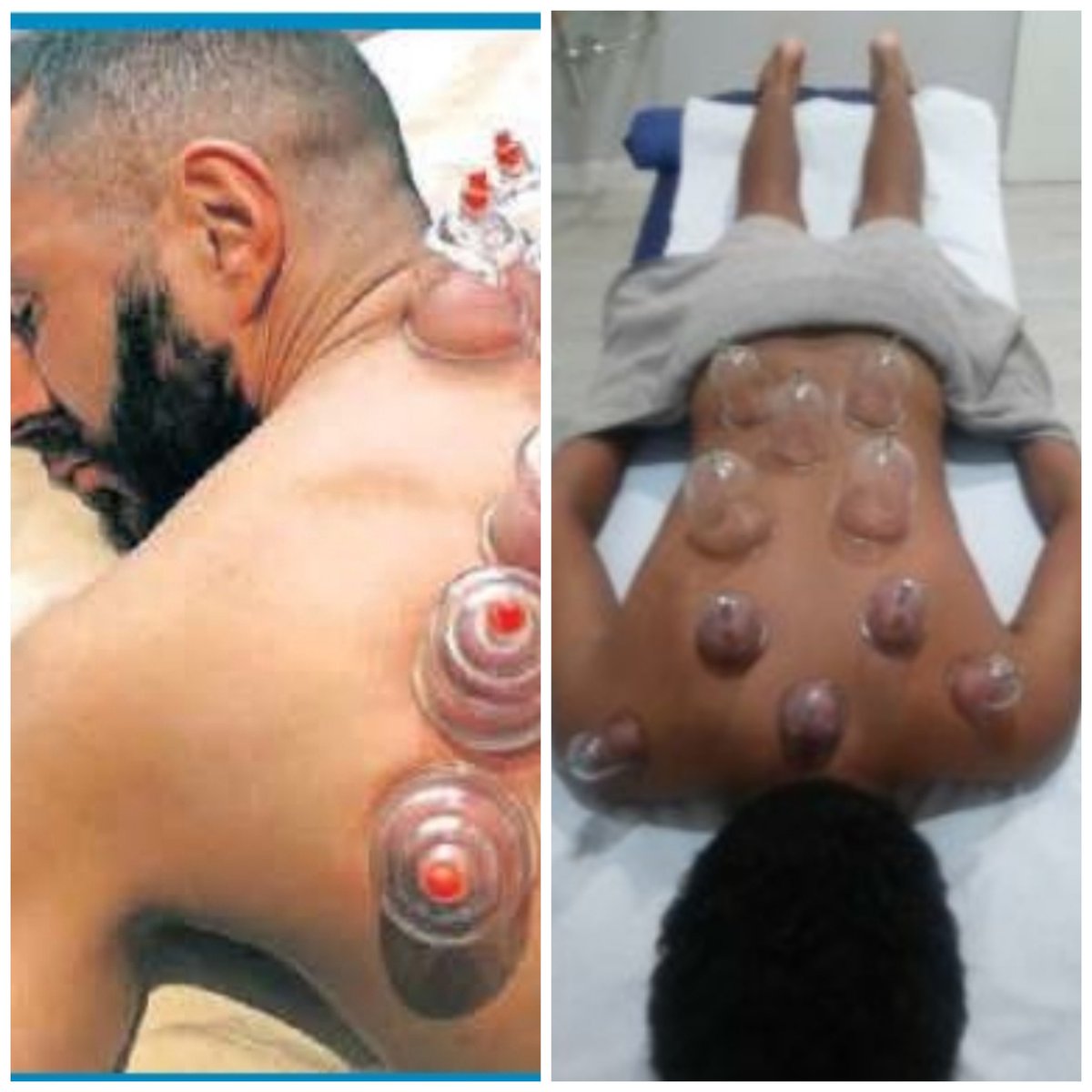 MarcosSanchezG's tweet photo. Como muchos números 1...@juanlebronc y @Benzema se recuperan con el #cupping...rumbo al repoker!!! https://t.co/qtKoOfBq1w