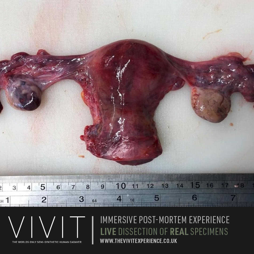 Here is the uterus removed along with its fallopian tubes and ovaries in a procedure known as total hysterectomy with bilateral salpingo oophorectomy. This type of hysterectomy is only recommended when there's a significant risk of further problems.

thevivitexperience.co.uk
#STEM