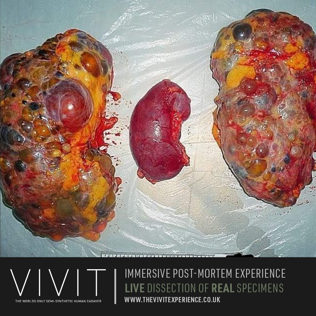 Polycystic kidney disease (PKD or PCKD, also known as polycystic kidney syndrome) is a genetic disorder in which the renal tubules become structurally abnormal, resulting in the development and growth of multiple cysts within the kidney.

thevivitexperience.co.uk
#kidneys #kidney