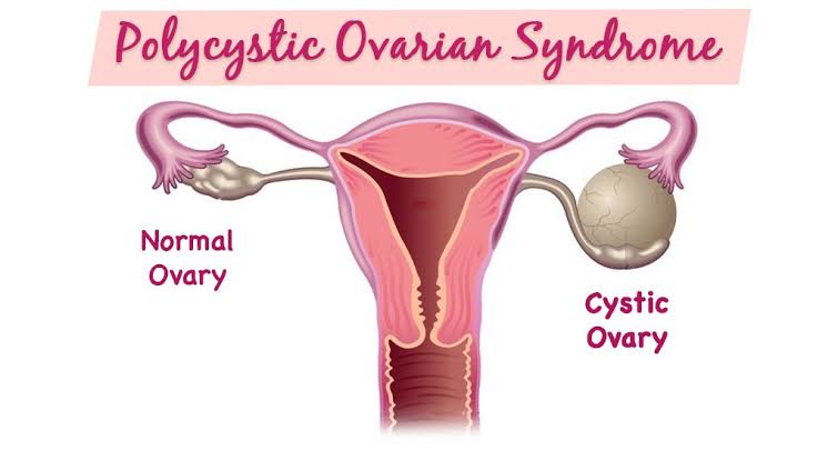 • What Is POLYCYSTIC OVARIAN SYNDROME (PCOS)?- It's a COMMON hormonal disorder found in women of child bearing age i.e (12 - 50yrs).- The ovaries develops small collections of fluid called (Follicles) and may fail to release eggs regularly causing irregular menstruation.