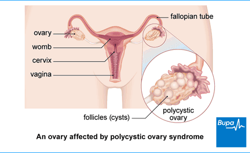 • What Is POLYCYSTIC OVARIAN SYNDROME (PCOS)?- It's a COMMON hormonal disorder found in women of child bearing age i.e (12 - 50yrs).- The ovaries develops small collections of fluid called (Follicles) and may fail to release eggs regularly causing irregular menstruation.