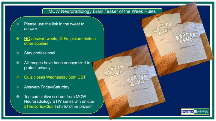 PublishedXPrime's tweet photo. #MCWNeuroradBTW 005: Conductive Hearing Loss

Submit answers at:
https://t.co/mmurY8ruZD

This week the quiz closes Thu5pm d/t US LaborDay weekend. Ans Fri/Sat

PLEASE DO NOT POST ANSWERS, GIFs, HINTS etc IN COMMENTS 

#Radres #FOAMed #MedEd #NeuroTwitter #RadEd #FOAMrad https://t.co/YbHpoNtFMI
