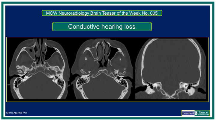 PublishedXPrime's tweet photo. #MCWNeuroradBTW 005: Conductive Hearing Loss

Submit answers at:
https://t.co/mmurY8ruZD

This week the quiz closes Thu5pm d/t US LaborDay weekend. Ans Fri/Sat

PLEASE DO NOT POST ANSWERS, GIFs, HINTS etc IN COMMENTS 

#Radres #FOAMed #MedEd #NeuroTwitter #RadEd #FOAMrad https://t.co/YbHpoNtFMI
