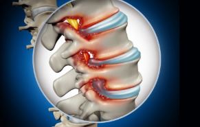 FNeirami's tweet photo. SPINAL STENOSIS
The spinal column contains open spaces that create passageways for the spinal cord and the spinal nerves. Spinal stenosis is a narrowing of (or an intrusion into) these openings. This can cause a compression of the nerves. 
#spine #stenosis #pain #nerve  #backpain https://t.co/EdsnqW77OH
