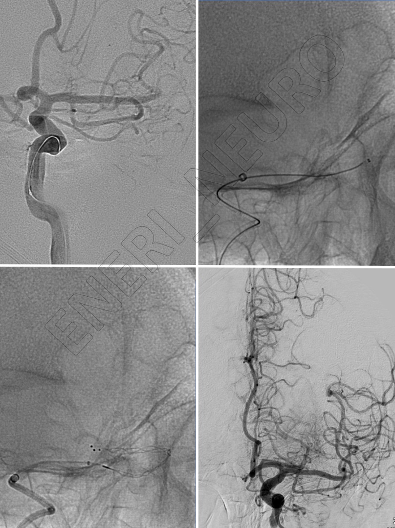 eneri_neuro's tweet photo. 75 y.o.
Aphasia 3hs of onset- Acenocumarol on the lower range for a mitral valve replacement
#goradial #godistal
#radialfirst
L-Superior trunk MCA thrombectomy through radial access
NIHSS 7-->1 https://t.co/lgjVXQ1o5M