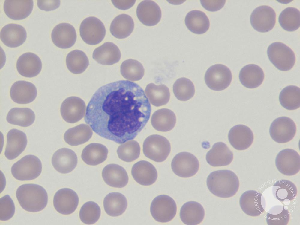 The “mononuclear” leukocytes include lymphocytes and monocytes. Lymphocyte nuclei are usually more condensed and round. Monocyte nuclei (which are actually usually “bilobed” - cleaved or kidney shaped - not “mono” lobed!) change shape when they differentiate into macrophages./6