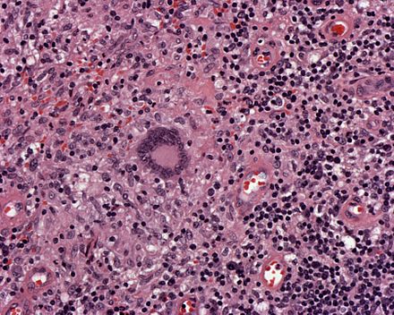 Sometimes mistaken for a megakaryocyte by new histology students are giant multinucleated Langhans-type macrophages, which can be seen in granulomatous disorders. These arise differently: not endomitosis, but fusion of multiple epitheloid macrophages, mediated by CD40/CD40L. /11