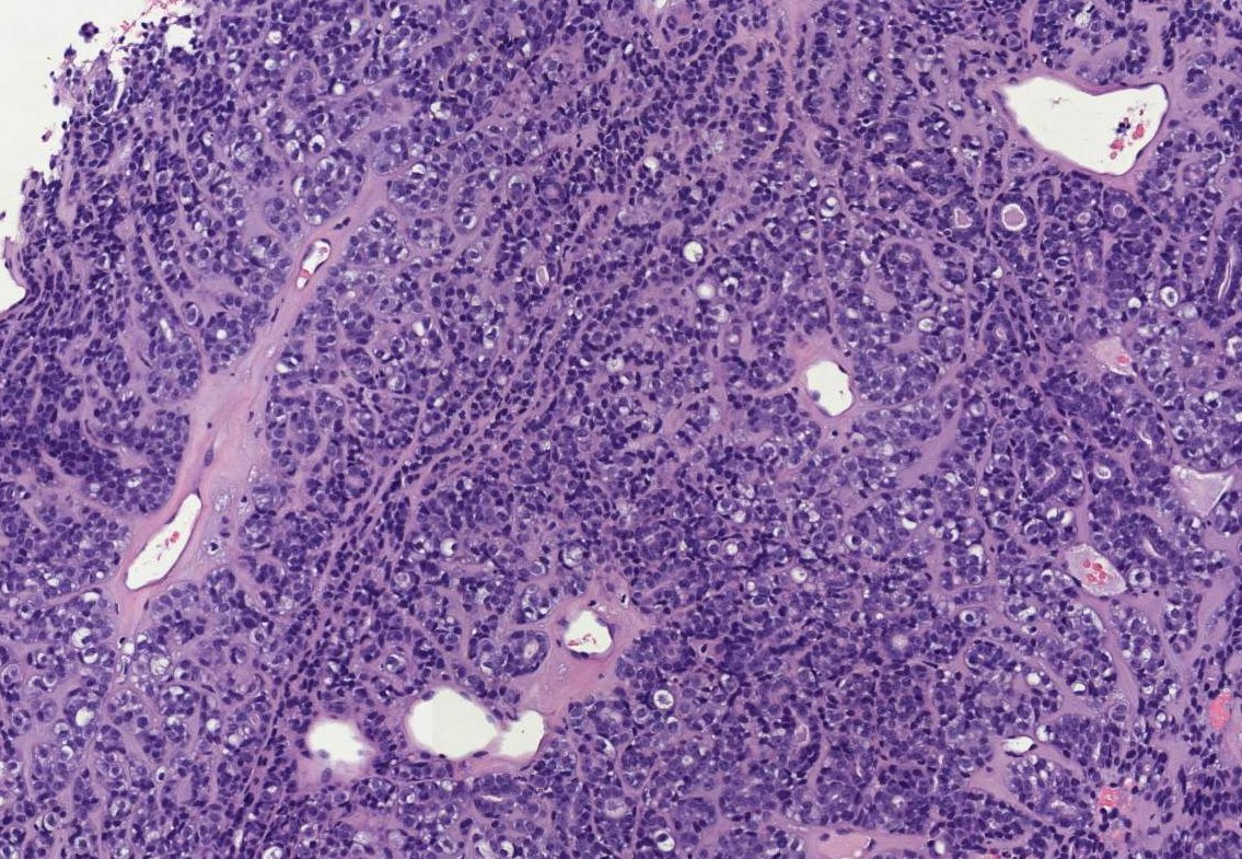 Anshehabeldin's tweet photo. Adenomyoepithelioma of the breast:
•Recognition of the two population of cells, epithelial and myoepithelial, is key
•Mostly benign 
•Can have local recurrence and distant metastasis 
•Tumors with malignant behavior have nuclear atypia and increased mitosis
#breastpath https://t.co/1dvWdx7OR9