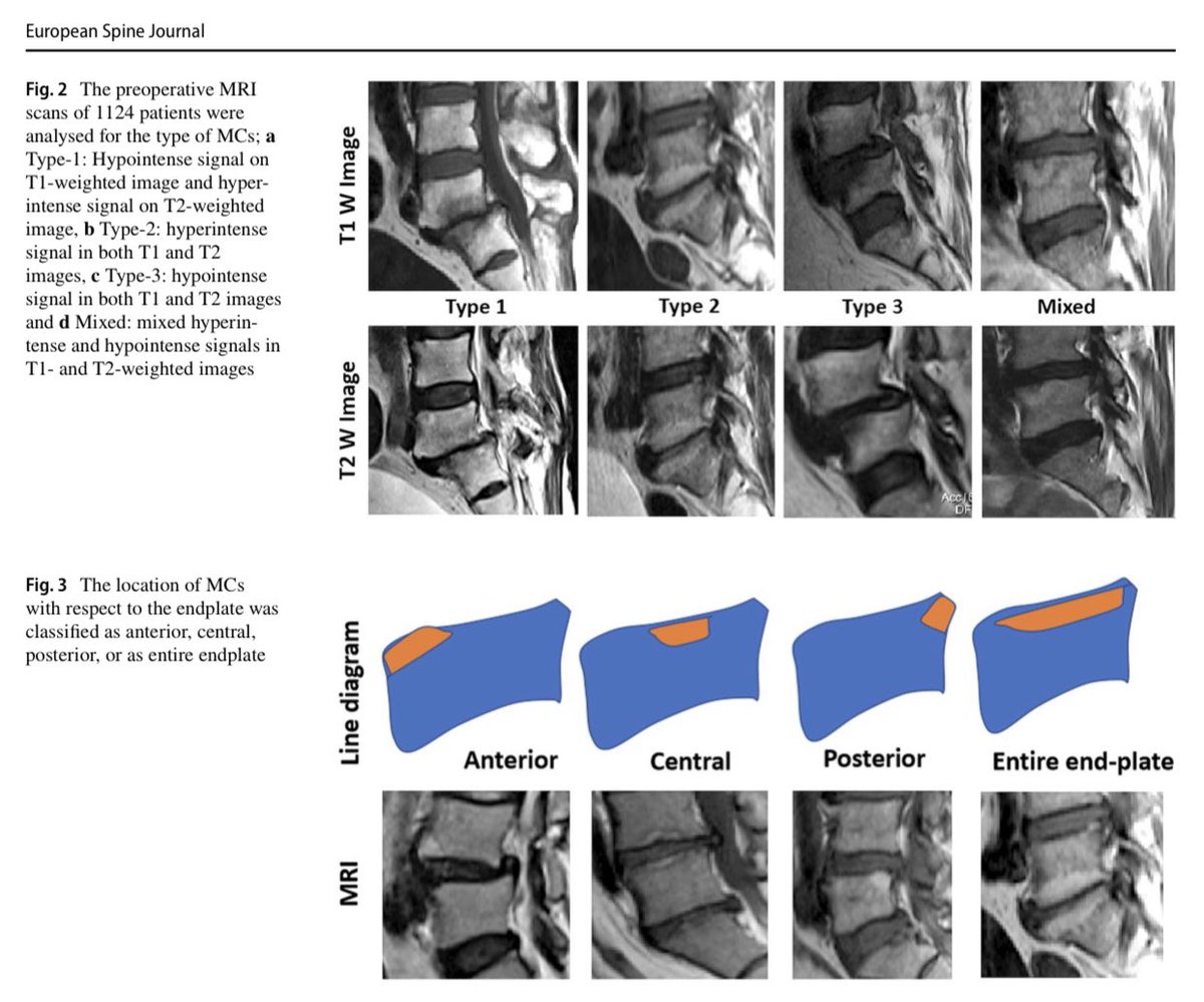 EurSpineJournal's tweet photo. Are preoperative #Modic changes and severity of #endplate damage score independent risk factors for developing surgical site #infections.
https://t.co/HE3l0HN88F https://t.co/GS3AwZFBrz
