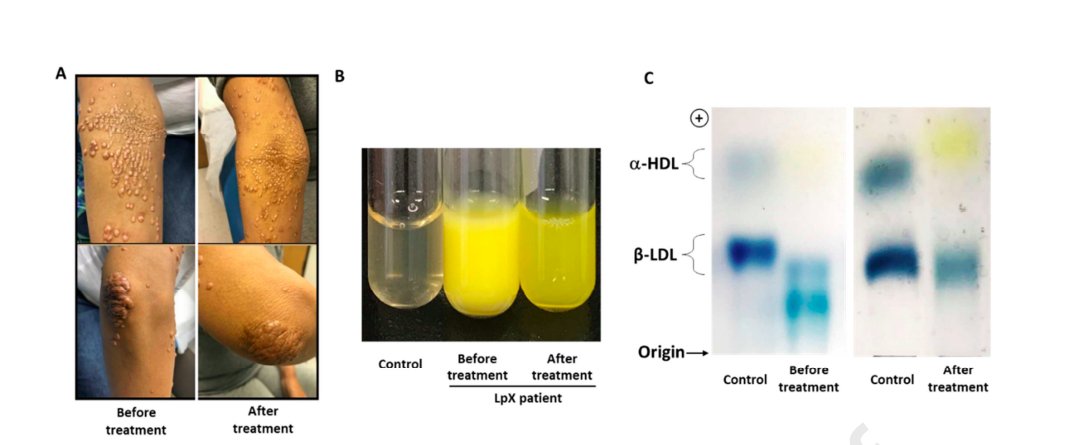 Anum Saeed (@anumsaeedmd) on Twitter photo ✨Excited to share our paper on 'Monocyte Phenotyping & Management of #LipoproteinX Syndrome' in-press <a href="/LipidJournal/">Journal of Clinical Lipidology</a> !!
✨Plasmapheresis of an #LpX pt w/ ⬆️⬆️cholesterol & xanthomas & effect on monocyte phenotype in this clinic ↔️bench approach.
👉 bit.ly/3byYjUL 1/2 ✨Excited to share our paper on 'Monocyte Phenotyping & Management of #LipoproteinX Syndrome' in-press <a href="/LipidJournal/">Journal of Clinical Lipidology</a> !!
✨Plasmapheresis of an #LpX pt w/ ⬆️⬆️cholesterol & xanthomas & effect on monocyte phenotype in this clinic ↔️bench approach.
👉 bit.ly/3byYjUL 1/2