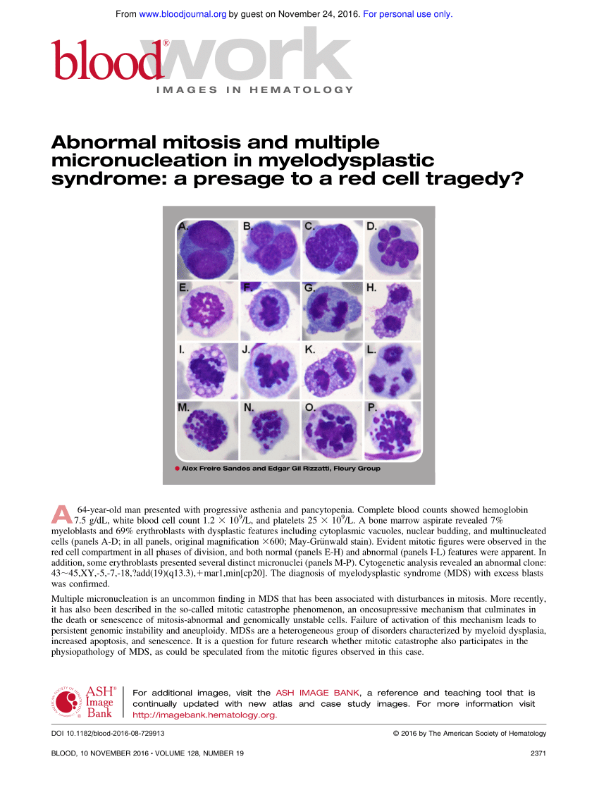 The opposite type of lobation defect may happen in myelodysplastic syndromes  #MDS: a megakaryocyte might have just a single-lobed nucleus like the ones below at left, or just 2 lobes, while MDS neutrophils may only have 2 lobes (aka acquired or pseudo-Pelger–Huët anomaly)./18