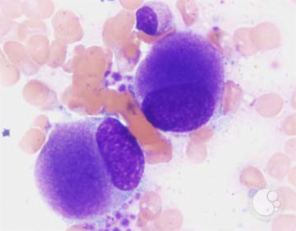The opposite type of lobation defect may happen in myelodysplastic syndromes  #MDS: a megakaryocyte might have just a single-lobed nucleus like the ones below at left, or just 2 lobes, while MDS neutrophils may only have 2 lobes (aka acquired or pseudo-Pelger–Huët anomaly)./18