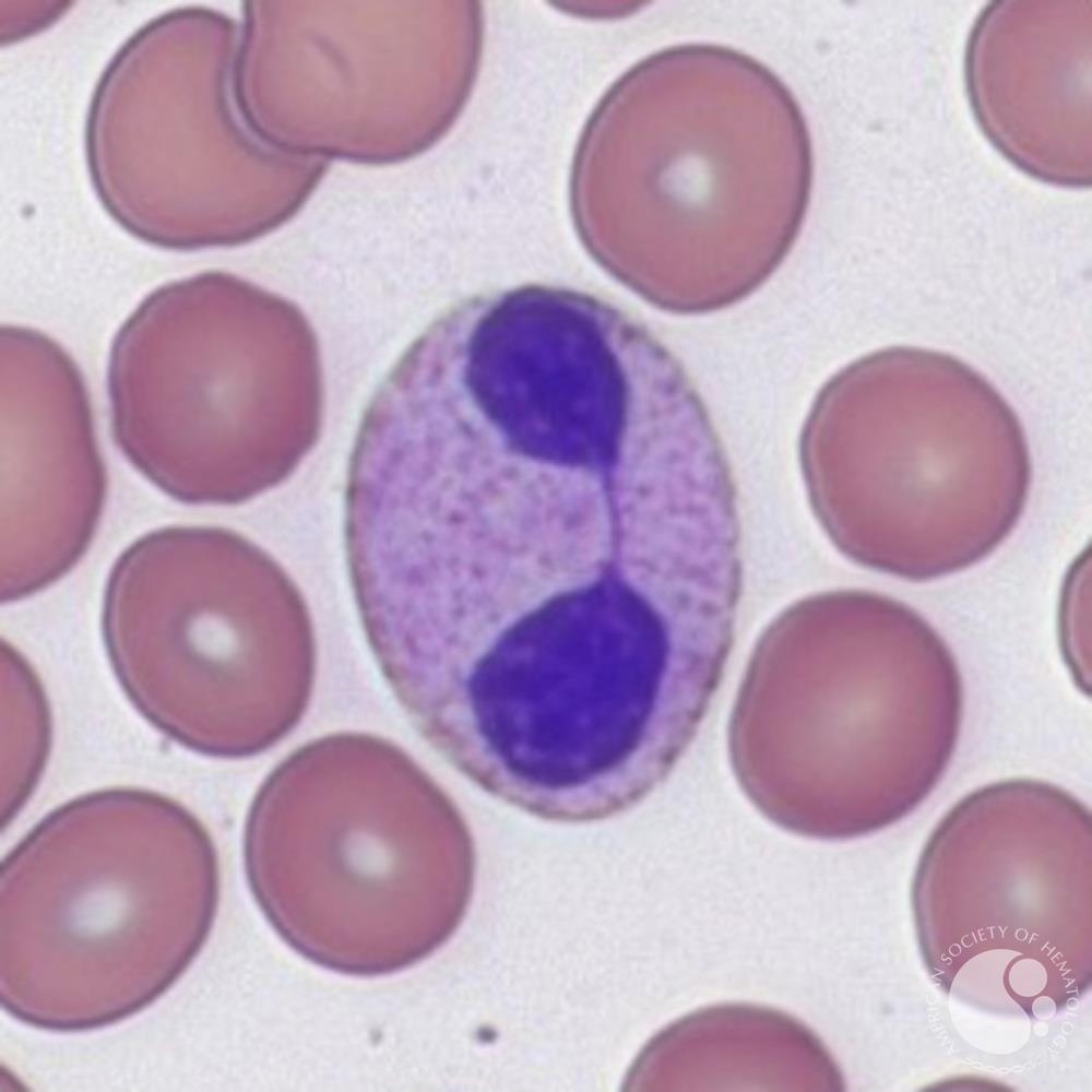 The opposite type of lobation defect may happen in myelodysplastic syndromes  #MDS: a megakaryocyte might have just a single-lobed nucleus like the ones below at left, or just 2 lobes, while MDS neutrophils may only have 2 lobes (aka acquired or pseudo-Pelger–Huët anomaly)./18
