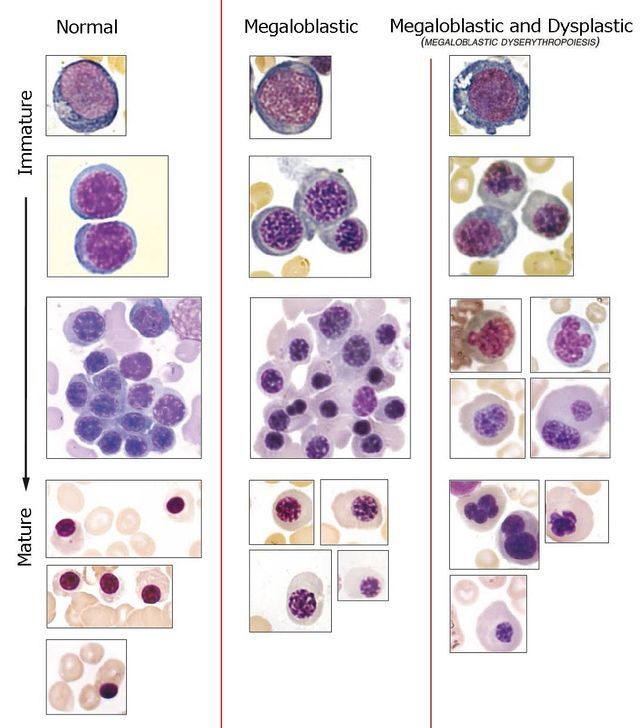 In megaloblastic/megaloblastoid maturation, there is nuclear-cytoplasmic asynchrony with chromatin in the nucleus more “open” (non-condensed) than it should be for the degree of cell maturation. In addition to B12/folate, one sees this w/ MDS & antimetabolites, eg MTX or Hydrea.