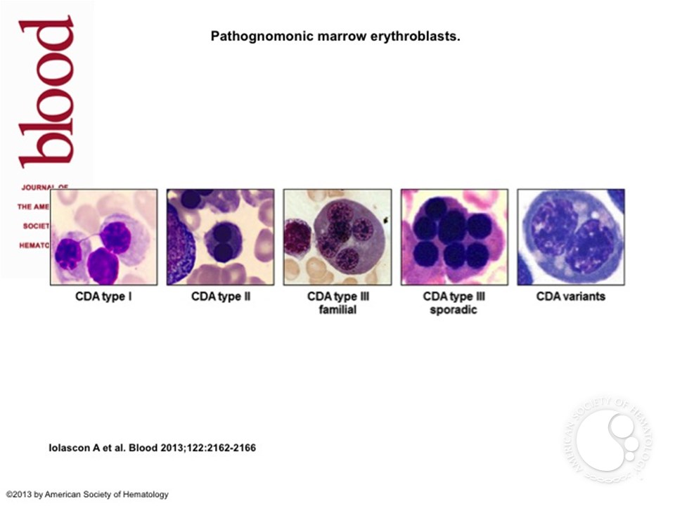 The congenital dyserythropoietic anemias (CDA) can have some really bizarre nuclear morphology. In CDA type 1 there is characteristic “nuclear bridging” from one red cell precursor to the next – as if the two sibling cells are unwilling to let go./24