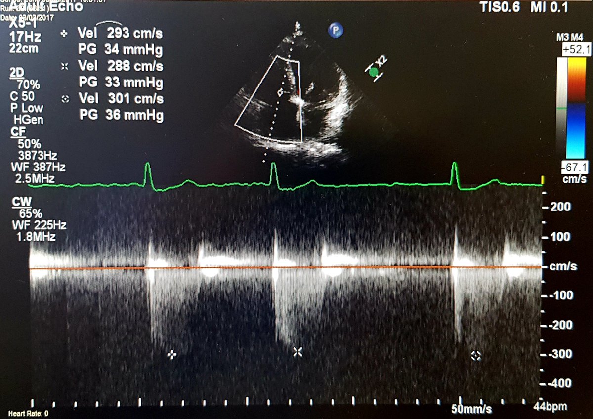 Here are the TR Doppler traces from this year (right) and 4yrs ago (left)... RVSP was ~20mmHg originally 6yrs ago.Also, LAVI has INCREASED with time from 80ml/m2 to 115ml/m2 and RV basal diameter has increased from 43mm to 51mm.But still totally asymptomatic and walking miles