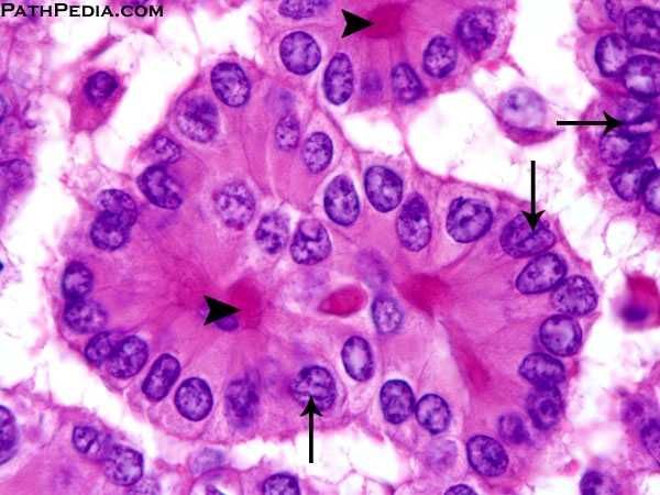 In addition to Orphan Annie nuclei, thyroid cancer cells can have a hazy “ground glass” nucleus. Ground glass most commonly used to describe an infiltrate pattern in the lung, which can indicate a range of pathologies – infections and inflammatory conditions.../32