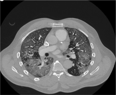 In addition to Orphan Annie nuclei, thyroid cancer cells can have a hazy “ground glass” nucleus. Ground glass most commonly used to describe an infiltrate pattern in the lung, which can indicate a range of pathologies – infections and inflammatory conditions.../32