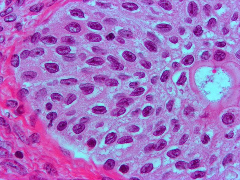 One food metaphor relevant to our discussion is “coffee bean nucleus”, classically seen in Brenner tumor of the ovary, or granulosa tumors but sometimes seen in Langerhans (!) histiocytosis or thyroid cancer. This Brenner tumor image is from Borah et al, J Midlife Health 2011./36
