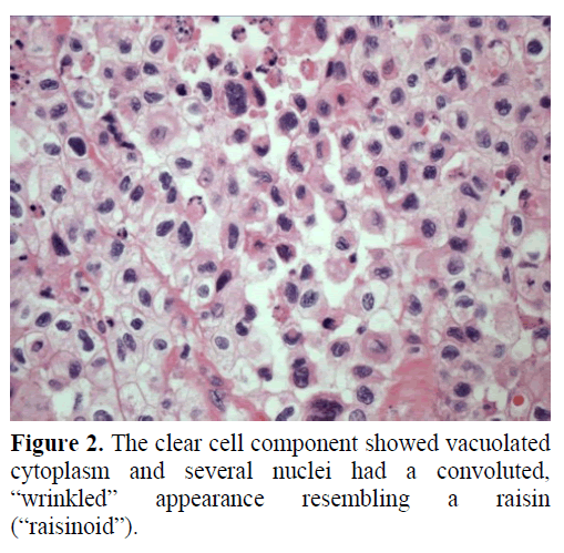 Another food nucleus is the “raisin nucleus”, with coarse chromatin and a wrinkled nuclear membrane. It's a stretch, I know. I heard through the grapevine  that raisin nuclei can be seen in many different poorly differentiated carcinomas. Image is from the AUA./37