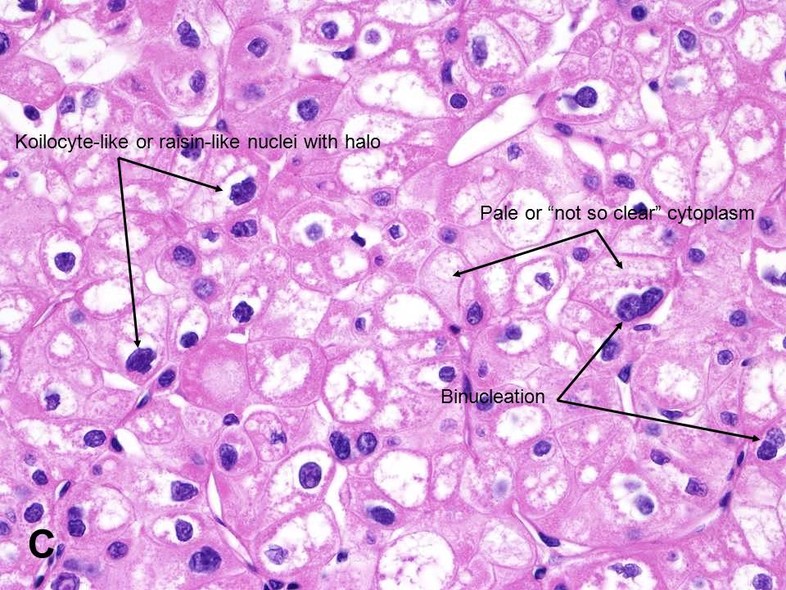 Another food nucleus is the “raisin nucleus”, with coarse chromatin and a wrinkled nuclear membrane. It's a stretch, I know. I heard through the grapevine  that raisin nuclei can be seen in many different poorly differentiated carcinomas. Image is from the AUA./37
