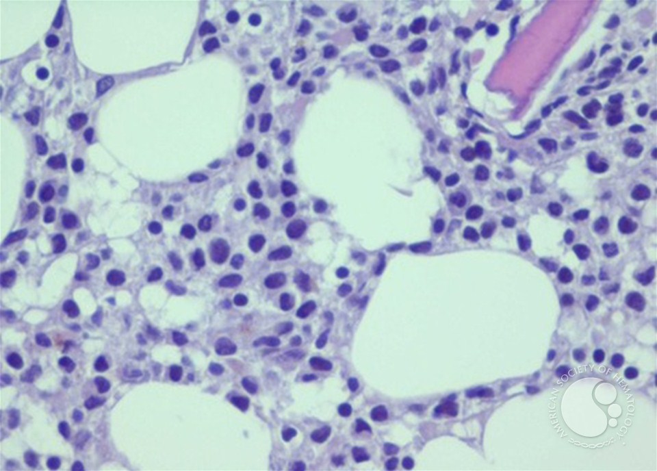 And the “fried egg” of hairy cell leukemia, where the round nuclei are the yolk. It is not a very specific pattern; there are other malignancies where the nucleus resembles a yolk in an egg./39