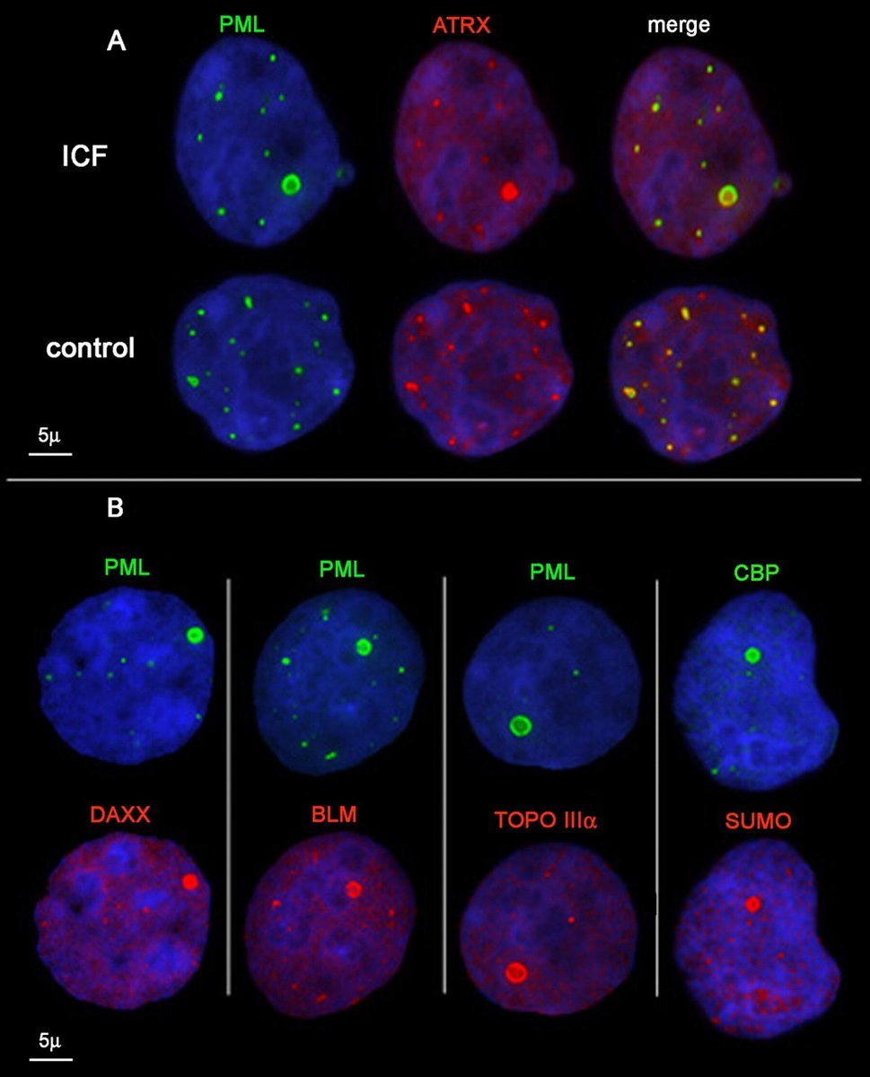 There are usually 5-30 PML nuclear bodies in mammalian cell nuclei; they range from 0.2-1 μm in diameter. This figure, from Luciani et ai 2006, shows ATRX (which I spent 2 years working on in the Higgs and Gibbons groups  @MRC_WIMM) and other proteins co-localize in PML bodies./44