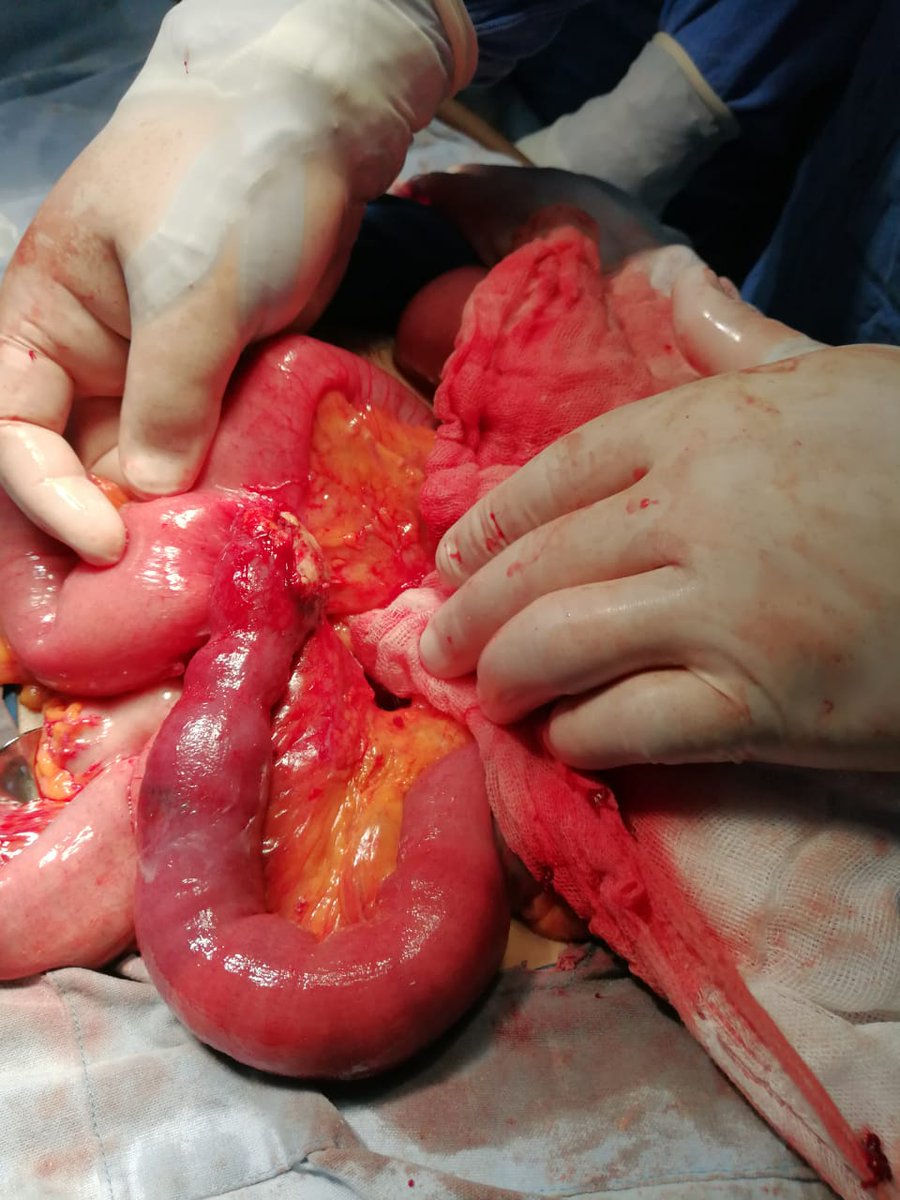ElCirugia's tweet photo. Tumor de íleon #reseccionintestinal https://t.co/3KAjQd9Ipx