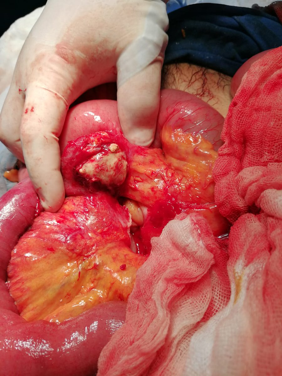ElCirugia's tweet photo. Tumor de íleon #reseccionintestinal https://t.co/3KAjQd9Ipx