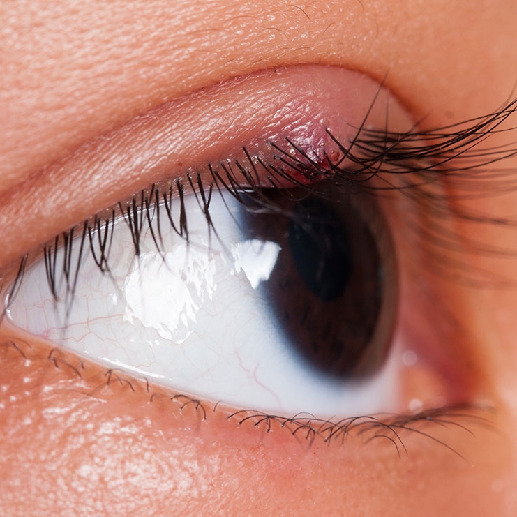 Beauty_by_Bug's tweet photo. A hordeolum, otherwise known as a stye, resembles a small pimple right on the eyelid. Ouch! 😫red from the nose to the eye.🤮 https://t.co/jkByRrj0EV