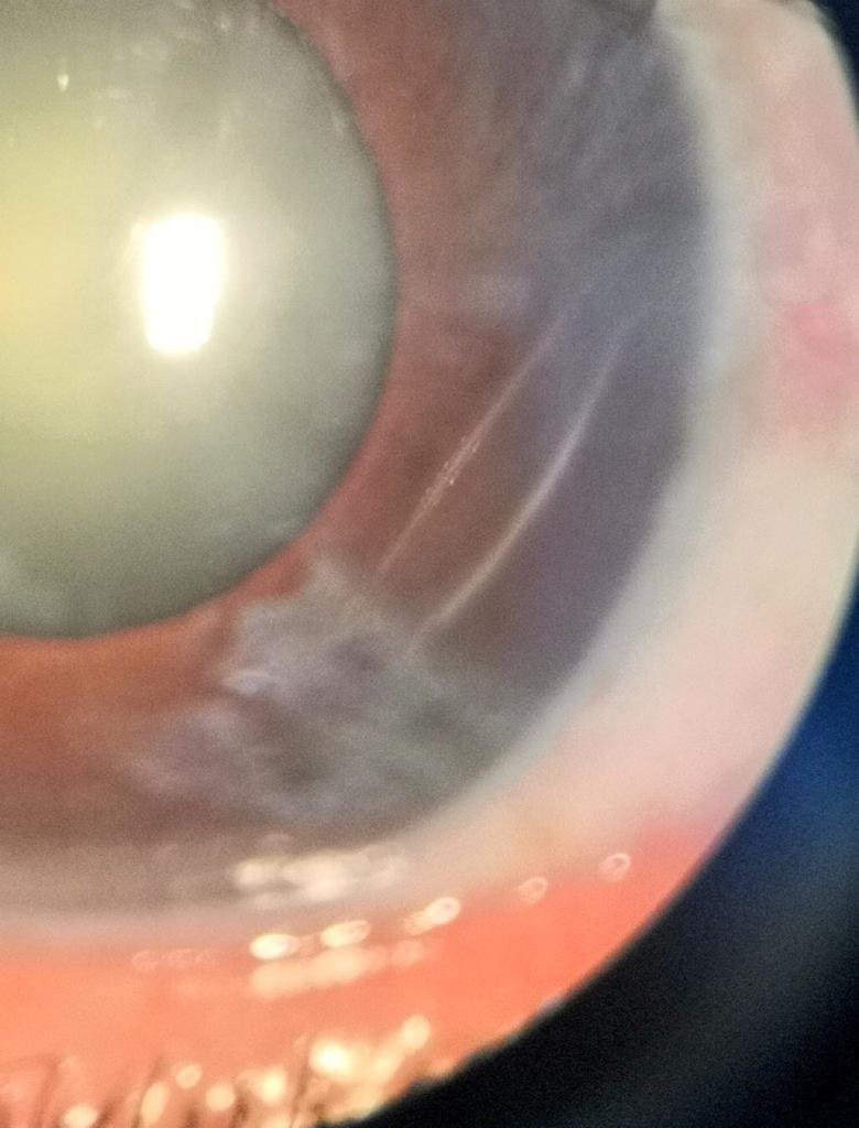 Signos patognomónico como las Estrías de Haab (rupturas horizontales de la membrana de Descemet) ayudan para el diagnóstico diferencial de las diversas opacidades corneales del RN