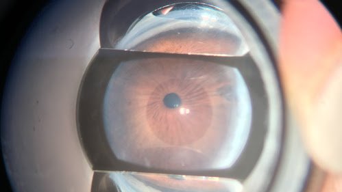 su origen esta dada por una disgenesia de la malla trabecular suelen ser casos esporádicos y la mayoría de los pacientes son hombres