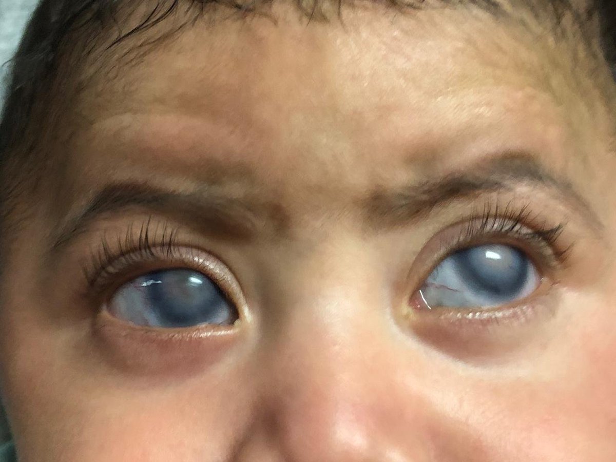 La tríada clásica es: Epífora, Blefarospasmo y Fotofobia. El espectro de presentación clínica es variada pero es característica incremento del diámetro corneal, edema corneal, buftalmos (coloración azulada de la esclera).