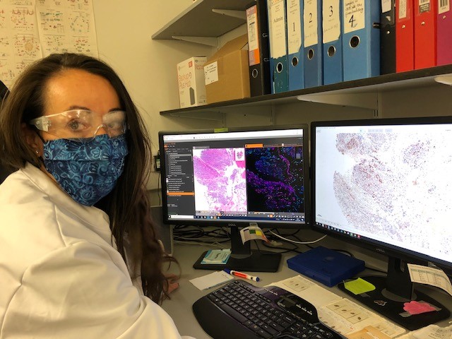 We enlisted the help of Leticia Campo and  @AlistairEaston from our own Translational histopathology lab  http://www.cancercentre.ox.ac.uk/centre-support/thl/ to convert these lab findings into something we could see. We used a Multiplex imaging to show how NUC-7738 affected Cheryl's tumour cells.