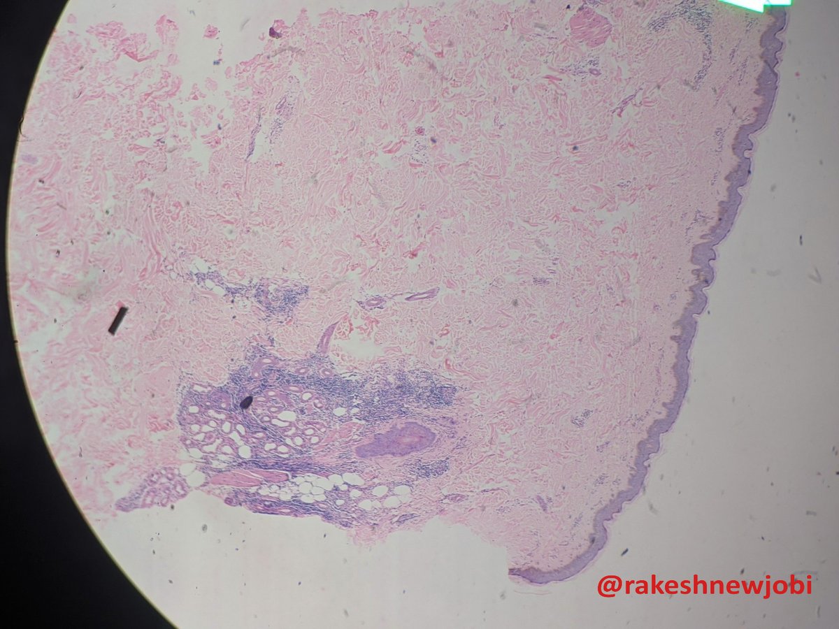 NewjobiRakesh's tweet photo. Middle aged female multiple erythematous plaque and papules x3months over chest (2-3 mm) ?Hansen's/EN/Sarcoid #dermpath path #Patholgy #Dermatology https://t.co/IvqZOcEkGN