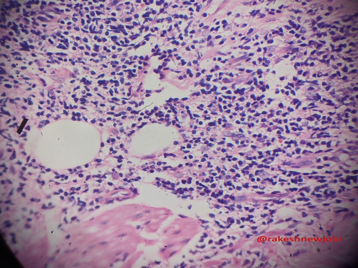 NewjobiRakesh's tweet photo. Middle aged female multiple erythematous plaque and papules x3months over chest (2-3 mm) ?Hansen's/EN/Sarcoid #dermpath path #Patholgy #Dermatology https://t.co/IvqZOcEkGN