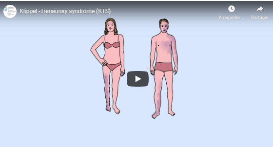 VASCERN (@vascern) on Twitter photo 6 new #subtitles added to the #KlippelTrenaunay syndrome #KTS #PoK video: #Dutch, #French, #German, #Italian, #Spanish and #Swedish! Share and raise awareness for this #raredisease : vascern.eu/six-new-langua… #ERNeu #vascularmalformation @HevasNederland <a href="/VASCAPA/">VASCAPA_asbl</a> <a href="/CMTCOVM/">CMTC-OVM</a> <a href="/LGDA_EU/">LGD Alliance Europe</a> 6 new #subtitles added to the #KlippelTrenaunay syndrome #KTS #PoK video: #Dutch, #French, #German, #Italian, #Spanish and #Swedish! Share and raise awareness for this #raredisease : vascern.eu/six-new-langua… #ERNeu #vascularmalformation @HevasNederland <a href="/VASCAPA/">VASCAPA_asbl</a> <a href="/CMTCOVM/">CMTC-OVM</a> <a href="/LGDA_EU/">LGD Alliance Europe</a>