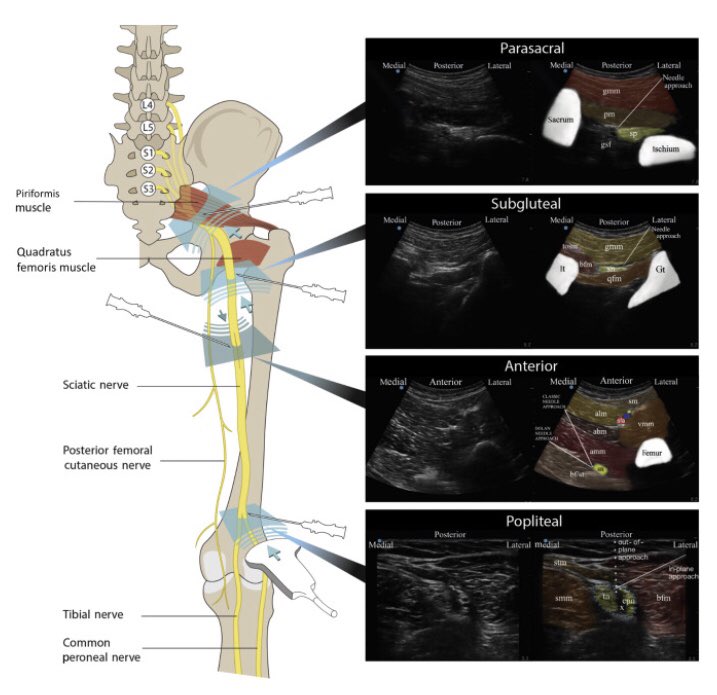 LloydTurbitt's tweet photo. Everything you’ve always wanted to know about sciatic nerve blocks.....and more. 🧐
https://t.co/68IIOBef0e

@sean_shevlin @davejohnston24 @ajrmacfarlane @RegionalAnaesUK https://t.co/IQKKwQ5XCi