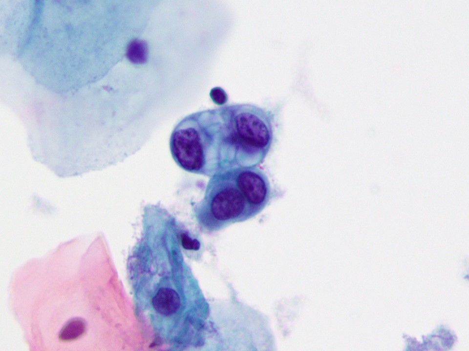 Hi All! I'm hoping to share more cases of  #cytopath mimics & pitfalls, either personal cases or cases that I come across from cyto-histo correlations and  #QA reviews. I hope that you can join too! Let's get a  #CytoPitfalls hashtag going so we can all learn from our experiences :D