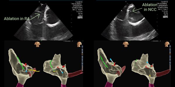 saumilshahmd's tweet image. AT ablation from RA/NCC. intracardiac echo is essential #viewflex ⁦@Frances_Salmon2⁩