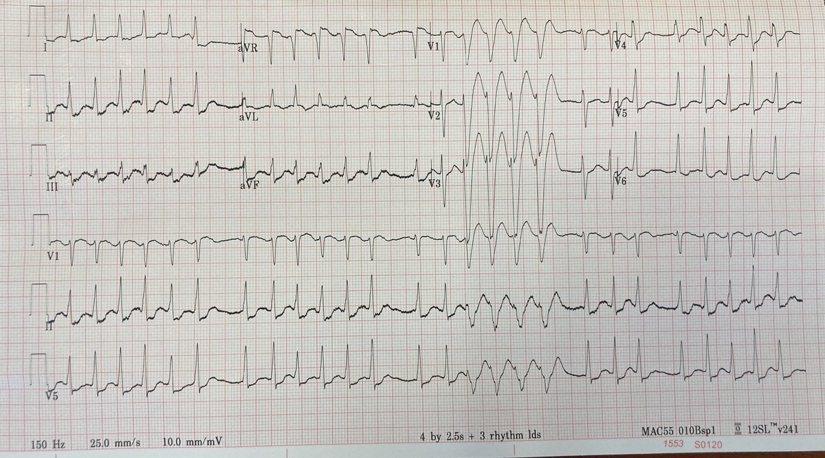 Patient being admitted for UTI develops this dysrhythmia and  #EKG yet is asymptomatic? What is this and what should we do?🤔 #FOAMed #MedEd #cardiotwitter